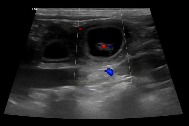 Peggy Ultraschall Peggy Ultraschall